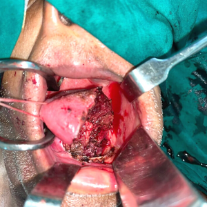 Therapies of oral cancer