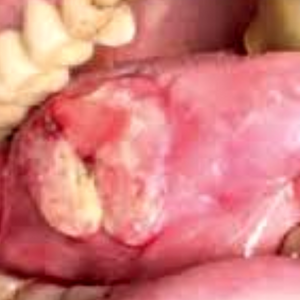 Effect of tobacco
